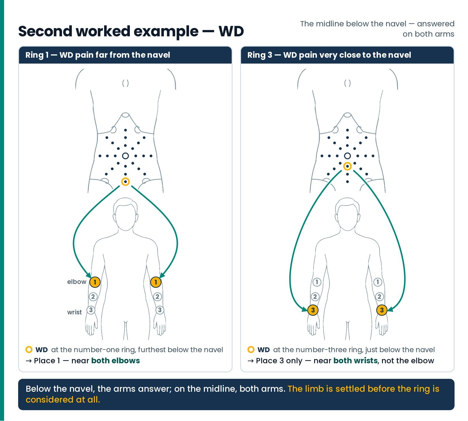 Second worked example — WD. WD, on the midline below the navel, is answered on both arms. Three stations run along each 